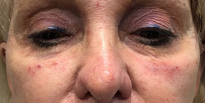 Tear Trough Filler After Photo of woman's eyes